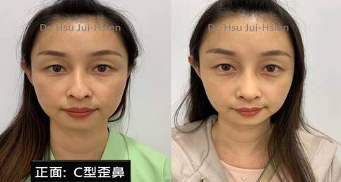 一次解決歪鼻、鷹鈎駝峰鼻、嚴重鼻塞三大問題！