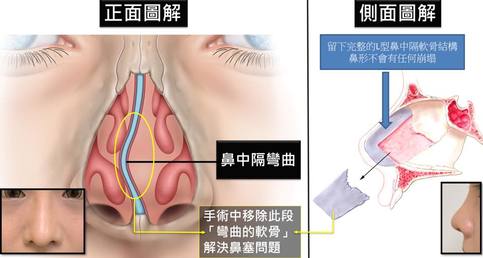 「鼻中隔彎曲矯正手術」四大常見問題