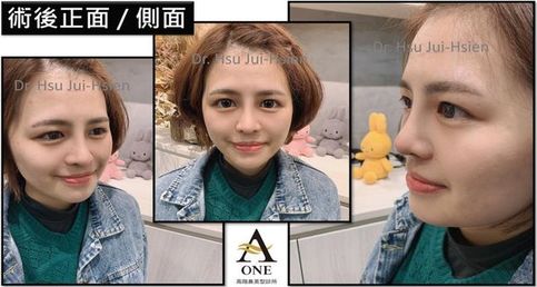 韓式三段式隆鼻 混血美鼻案例分享