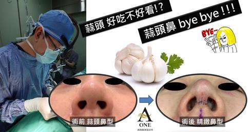 【鼻整形最常見問題】 - 蒜頭鼻