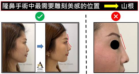 鼻整形手術哪部分最困難？