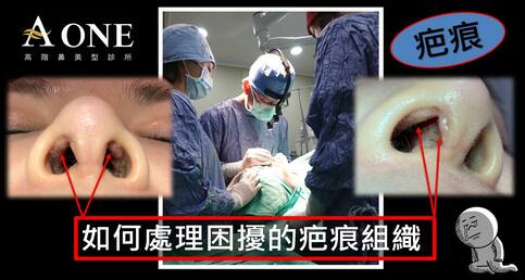 如何避免術後疤痕增生