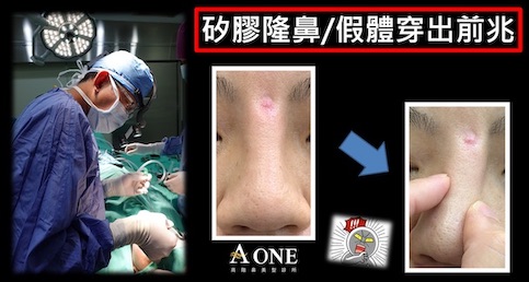 矽膠隆鼻/假體穿出前兆