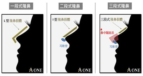 到底什麼是三段式隆鼻？