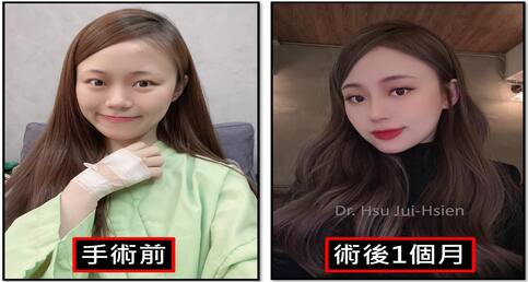 標準三段式隆鼻個案詳細紀錄✍️