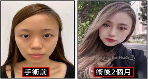 標準三段式隆鼻手術個案詳細紀錄✍️