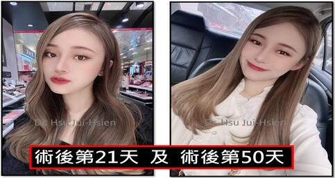 標準三段式隆鼻手術個案詳細紀錄✍️