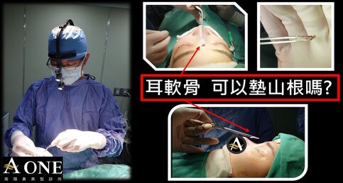耳軟骨隆鼻、墊山根？