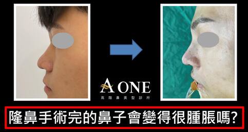 隆鼻術後會很腫嗎？第幾天最腫？
