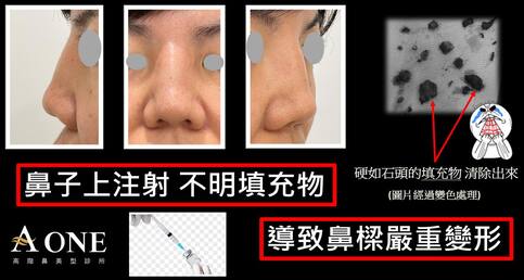 鼻上小針美容後遺症😱&注意事項️⚠️