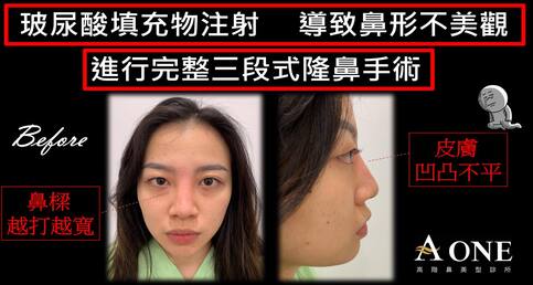 玻尿酸注射 導致鼻型不美觀👃