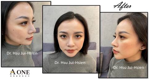 玻尿酸填充物注射 導致鼻型不美觀👃