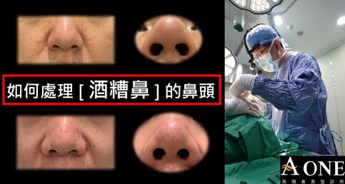 鼻頭紅紅腫腫的？可能是「酒糟鼻」
