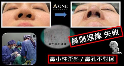鼻雕埋線失敗求救案例🆘