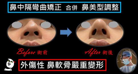 外力撞擊後遺症「鼻型歪斜+鼻塞」️