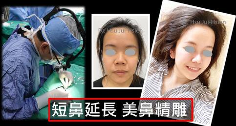 超短小朝天鼻完美延長+精雕🔪