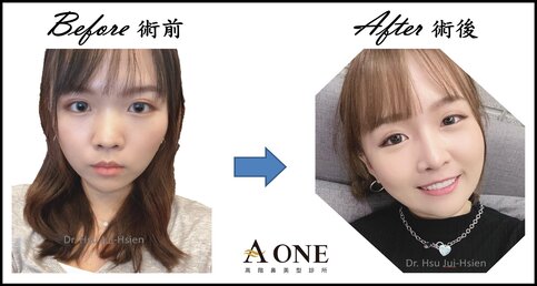 化妝後，隆鼻手術前後到底有沒有差？