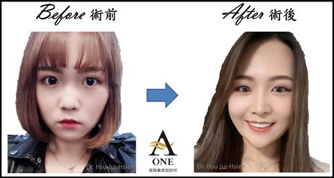 化妝後，隆鼻手術前後到底有沒有差？